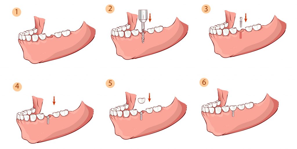 A series of steps showing how to drill through the teeth.