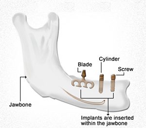 A picture of the parts of a jaw bone.