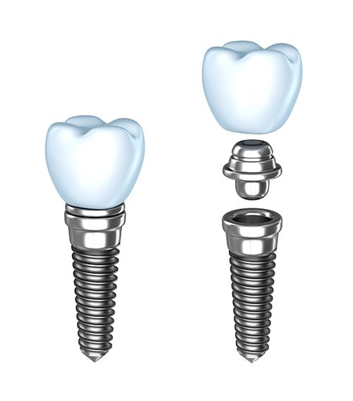 A set of two dental implants with the same size and shape.