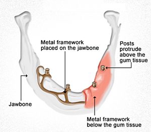 A diagram of the anatomy of a jawbone.