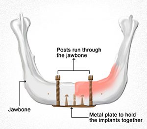 A diagram of the anatomy of a jaw bone.