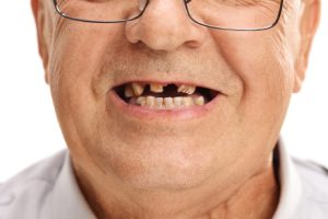 Affordable Dentures & Partial Dentures in Mexico