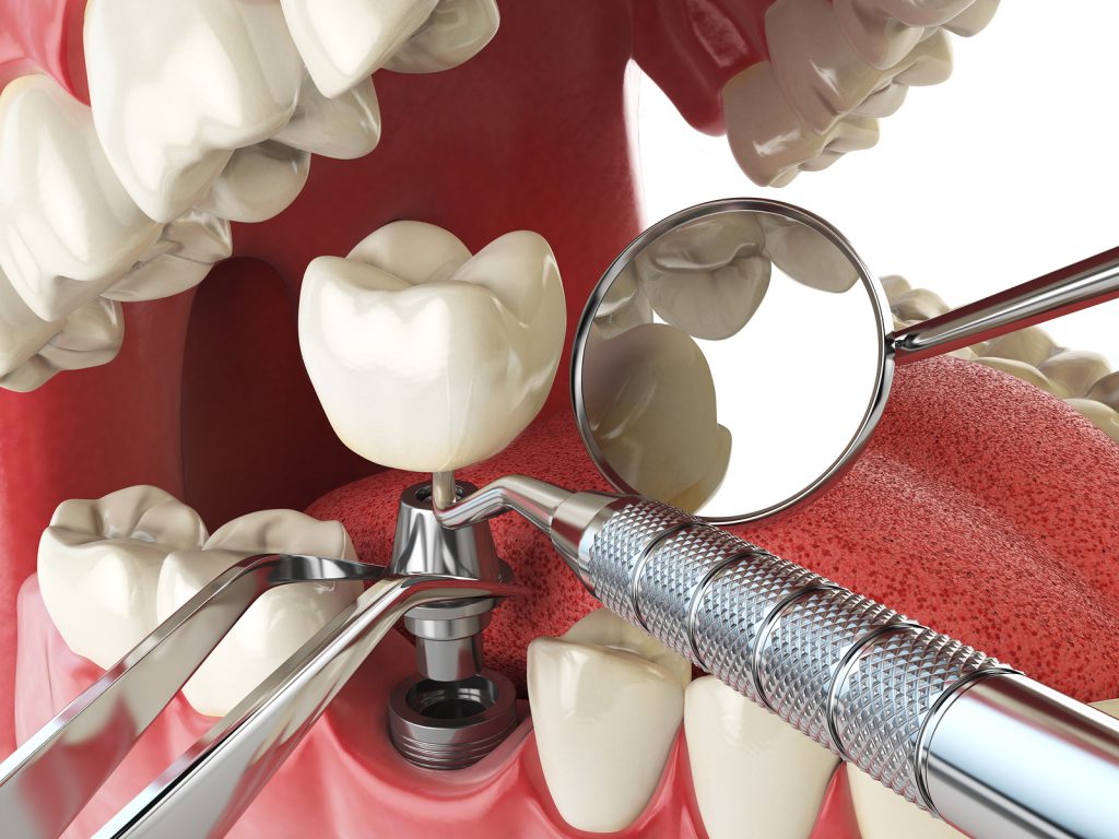 A dental implant being placed into the mouth of someone.