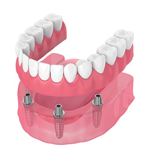 A model of an implant supported denture.