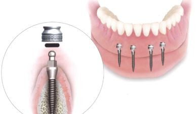 A picture of an implant supported denture with four pins.