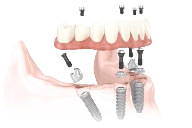 Dental Work in Mexico All-on-4s Non-Removeable Permanent Dentures