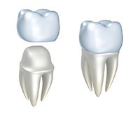 A tooth with two different types of crowns.