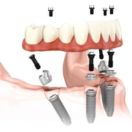 A diagram of the process of a dental implant.