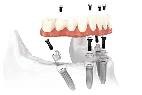 Nobel Biocare-ZirkonZahn-CAD-CAM-Systems Dental Implant Prosthetics