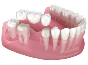A model of the teeth and gums are shown.
