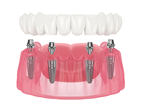 All-on-4 denture for Implant Restorations.