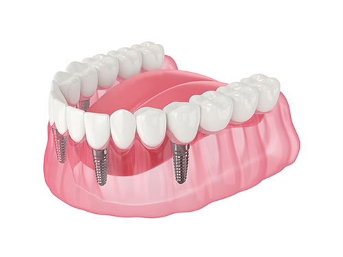 All-on-4 Hybrid Denture Implant Restorations.