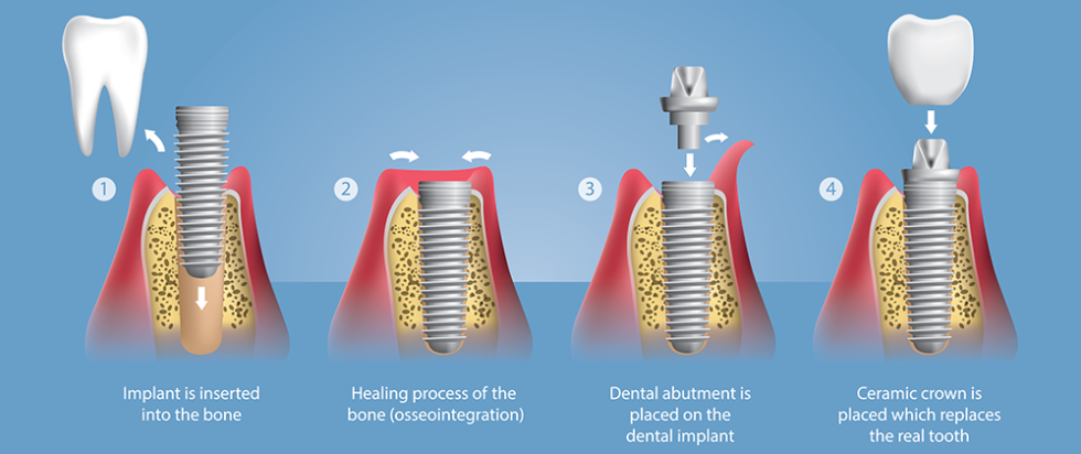 Dental Implants 101: The Basic Parts Of An Implant