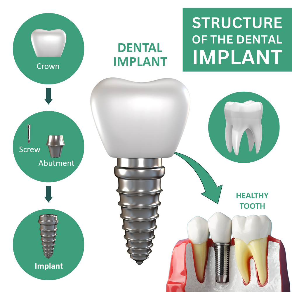 Endosteal Implants