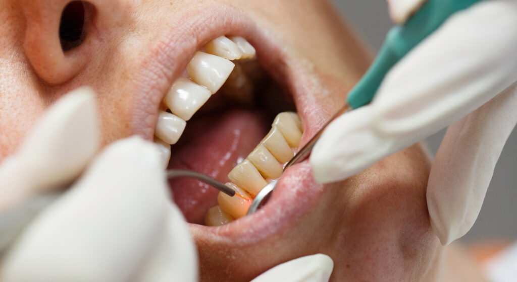 A patient is getting a dental exam. A patient is getting a dental exam.