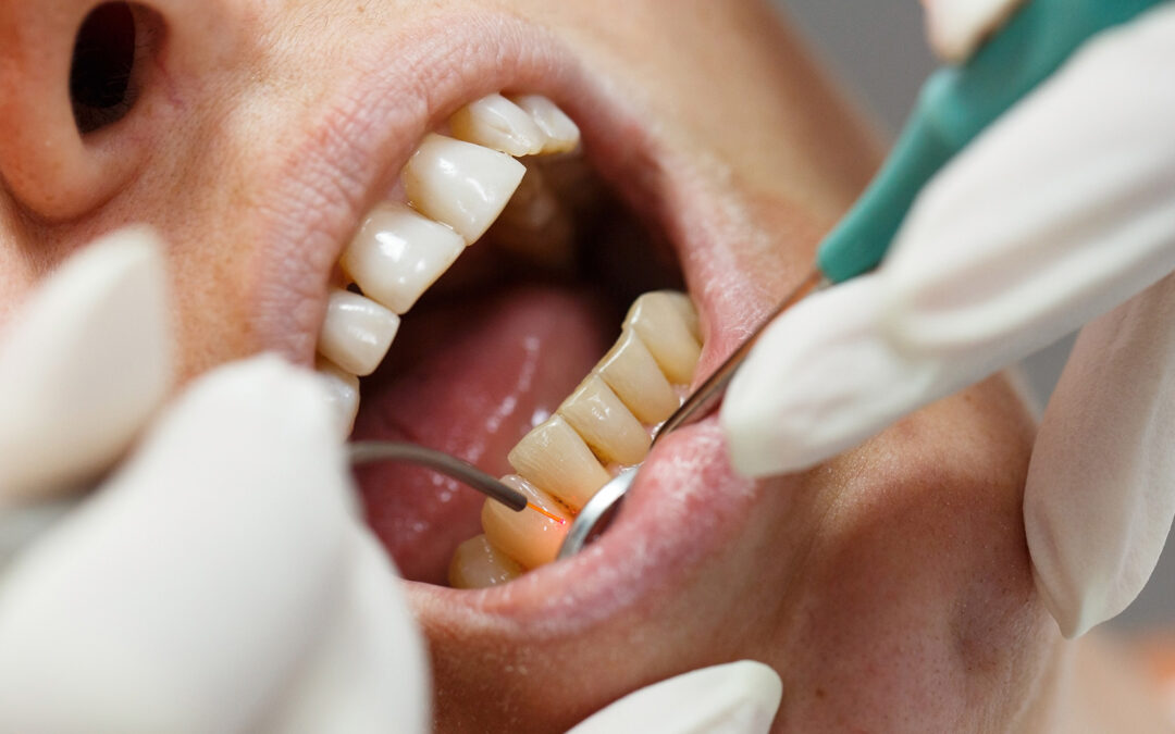 Fillings and Bonding Treatment.