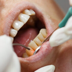 Fillings and Bonding Treatment