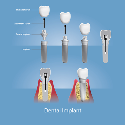 Single Implant Parts