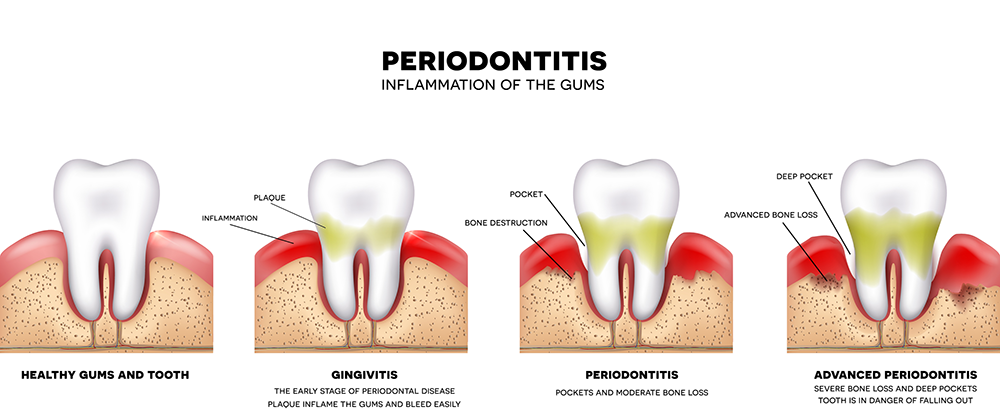Periodontitis, gum disease, periodontics, receding gums, periodontal disease