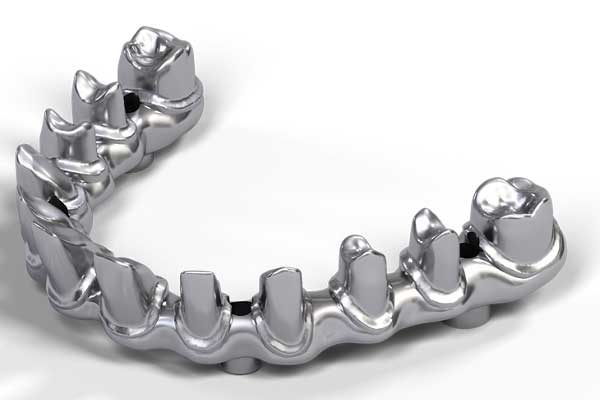 An image of an All-on-X implant supported bridge.