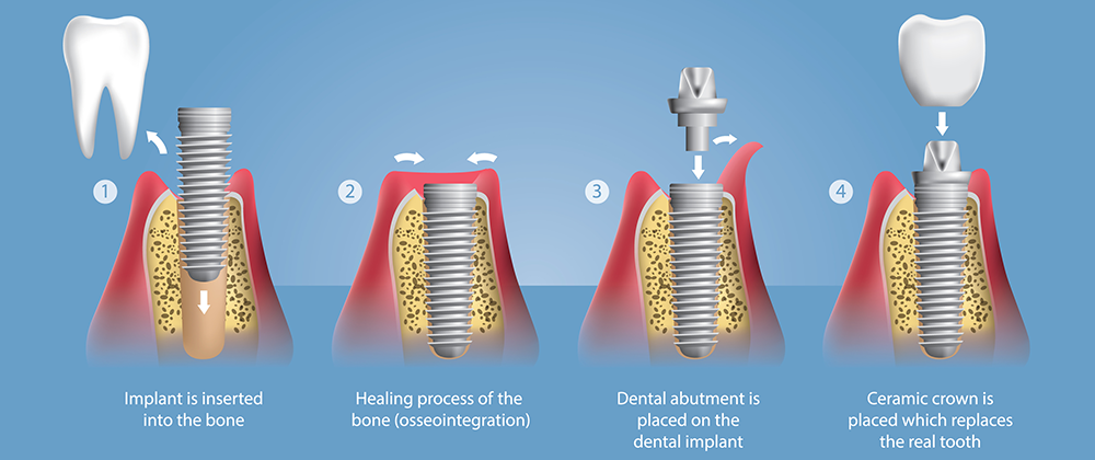 Parts of an implant