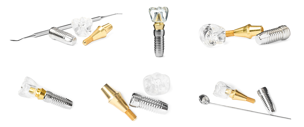 Types of Dental Implants: Costs and Benefits