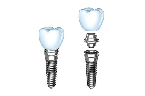 Endosteal Implants Dental Implant Types