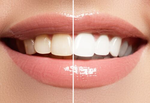 benefits of laser teeth whitening