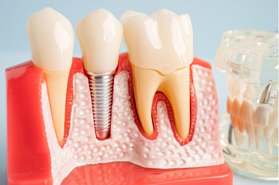 Dental Bridge vs Implant