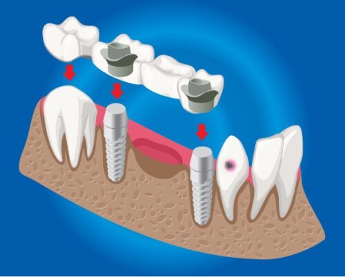 Dental Bridges 