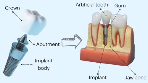 How abutments and dental implants work